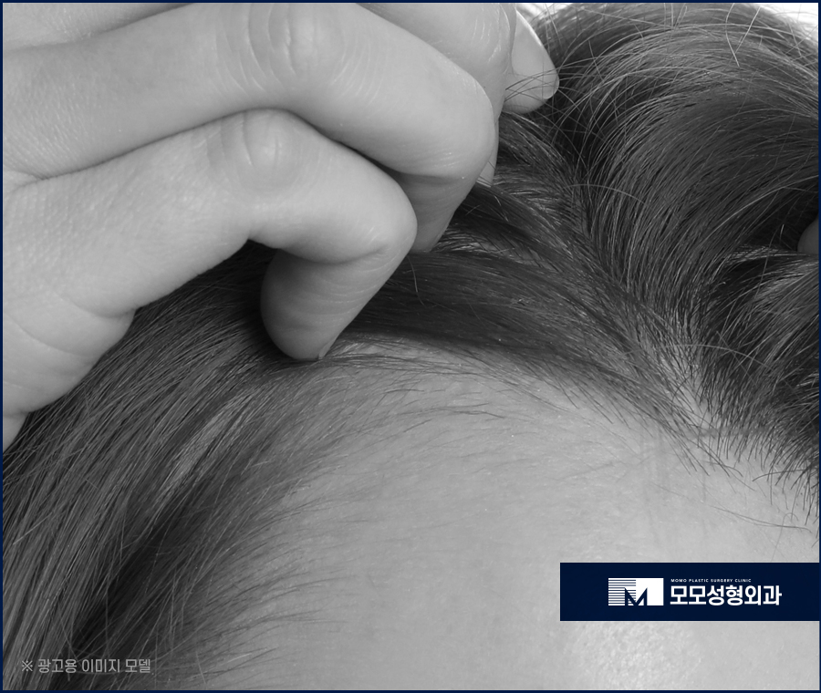 여자 헤어라인 모발이식 부작용 발생 우려를 낮춰야만 관련 이미지 5