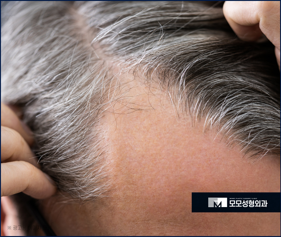 비절개모발이식가격 호전되는 방향으로 관련 이미지 2