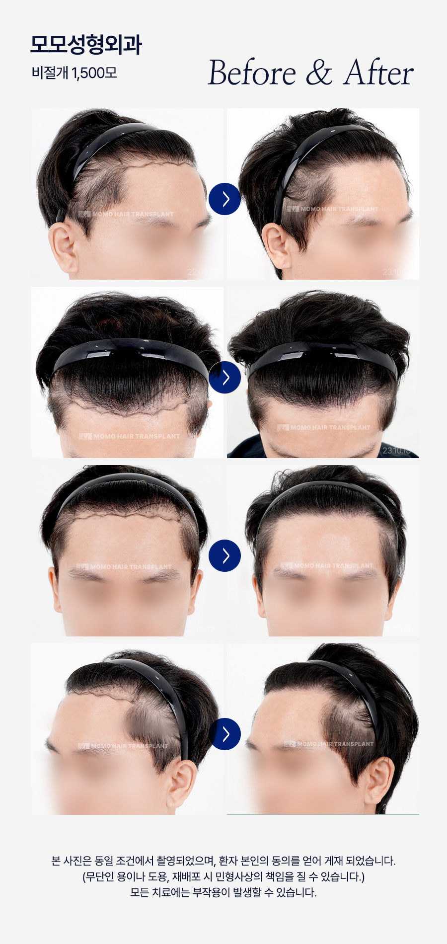 비절개 모발이식 후기와 함께 꼭 알아볼 이것! 관련 이미지 14