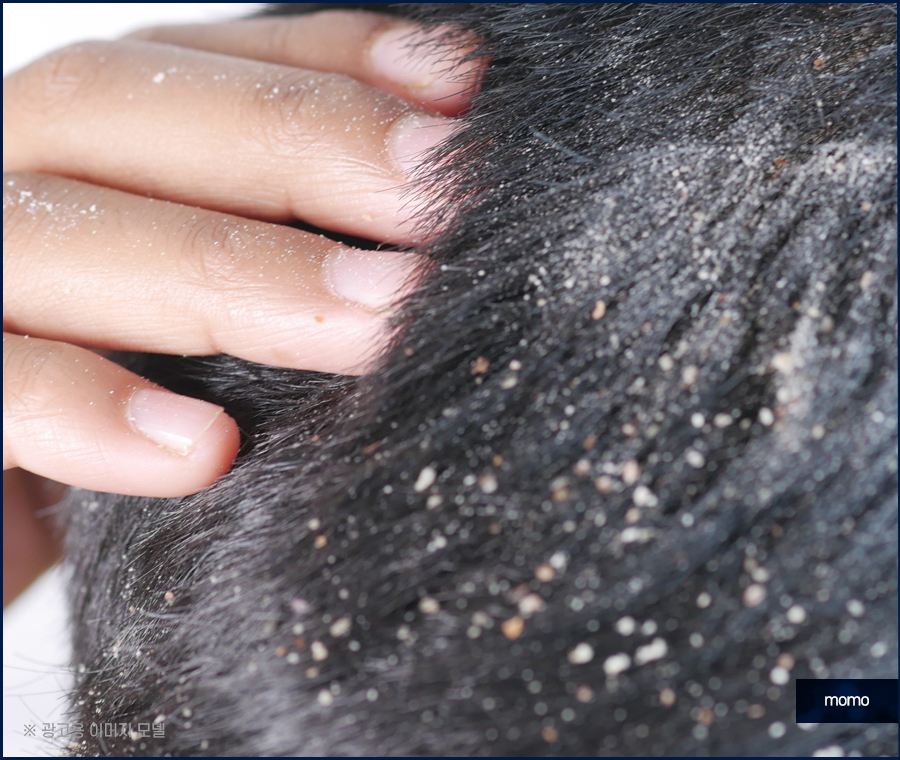 절개모발이식 차이점을 알고 정해야만 관련 이미지 3