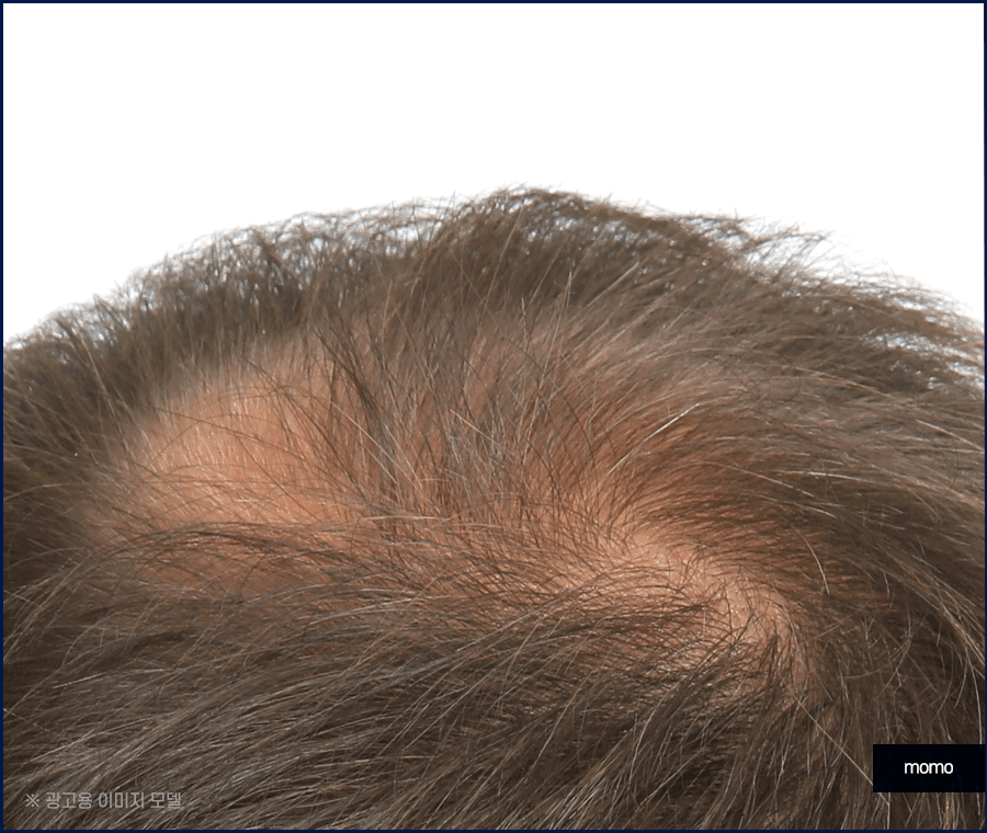 전두탈모 원인 보강을 위한 현명한 선택은? 관련 이미지 7