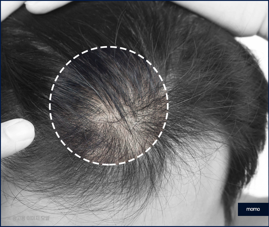 무삭발 모발이식 빠르게 회복하려면 관련 이미지 5