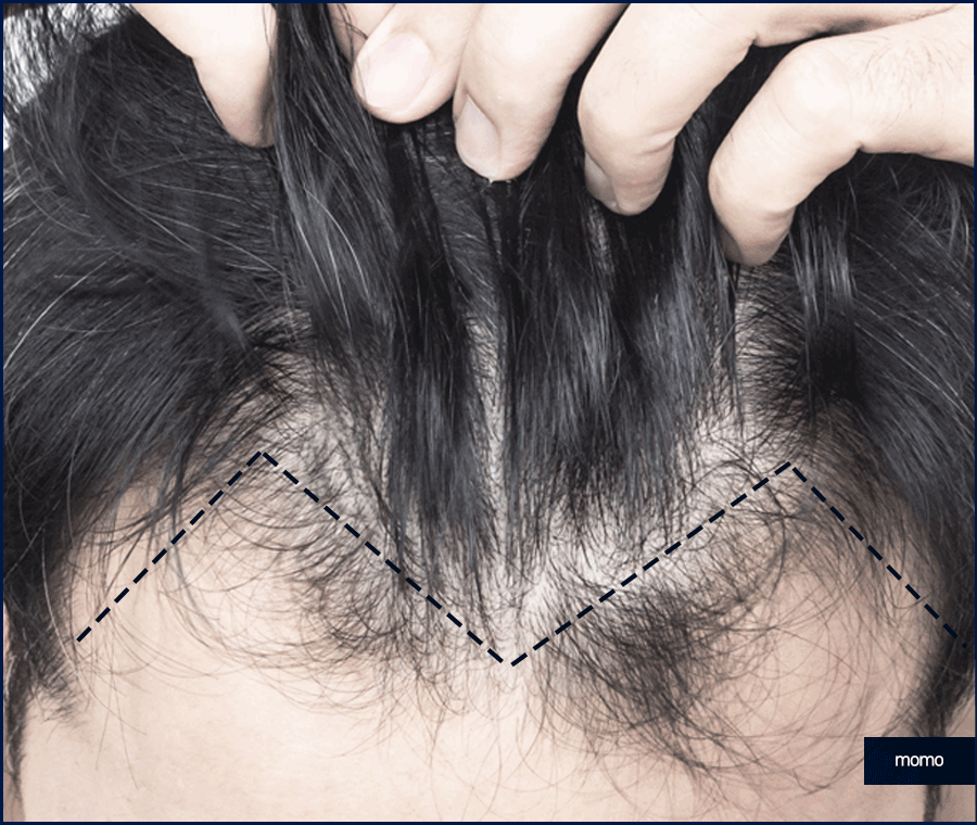 20대 모발이식 성공적인 결과를 위한 필수 조건 관련 이미지 7