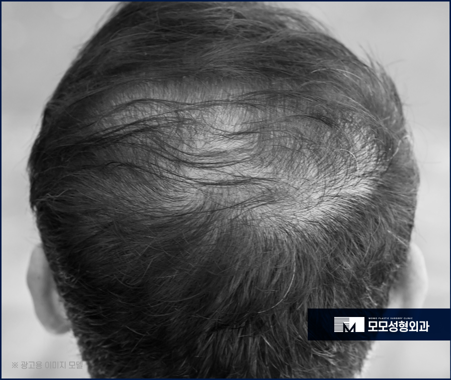 대량모발이식 부족하지 않게 채워가는 방향으로 관련 이미지 2