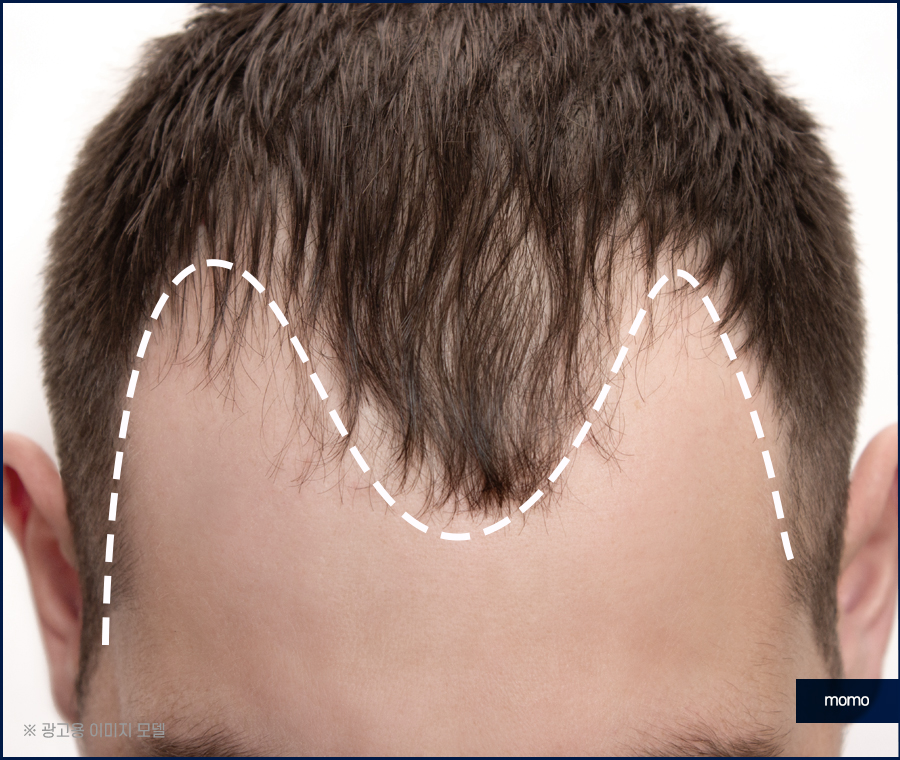 m자탈모초기 빠른 대처를 이뤄낸다면 관련 이미지 9