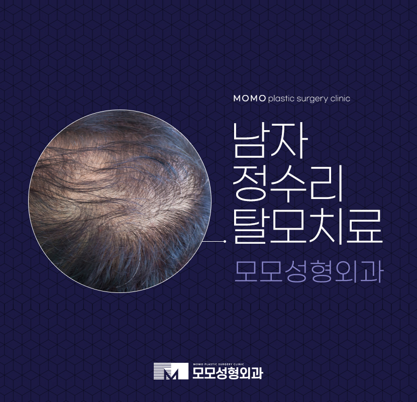남자정수리탈모치료 섬세하게 채워주는 관련 이미지 1
