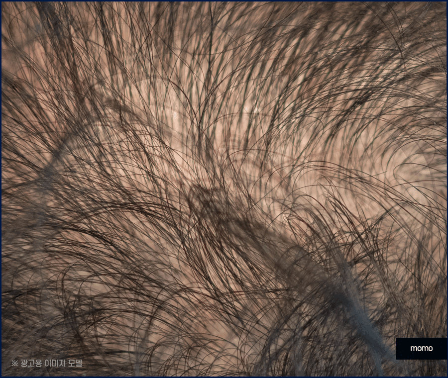 전두탈모 원인 보강을 위한 현명한 선택은? 관련 이미지 11