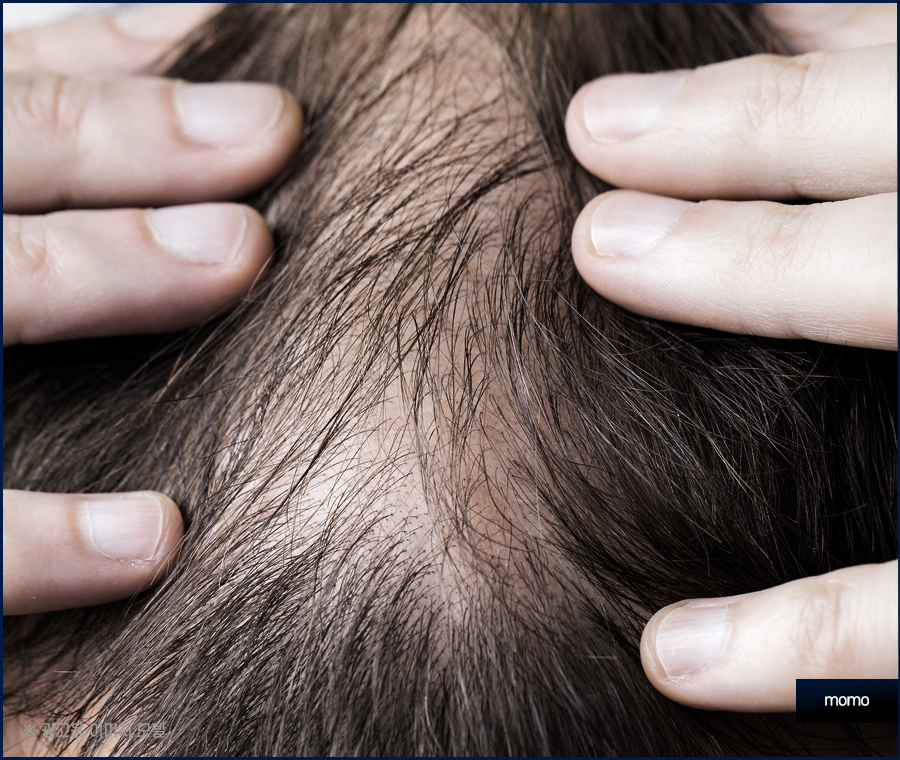 모발이식 생착률 극대화 하려면 관련 이미지 12