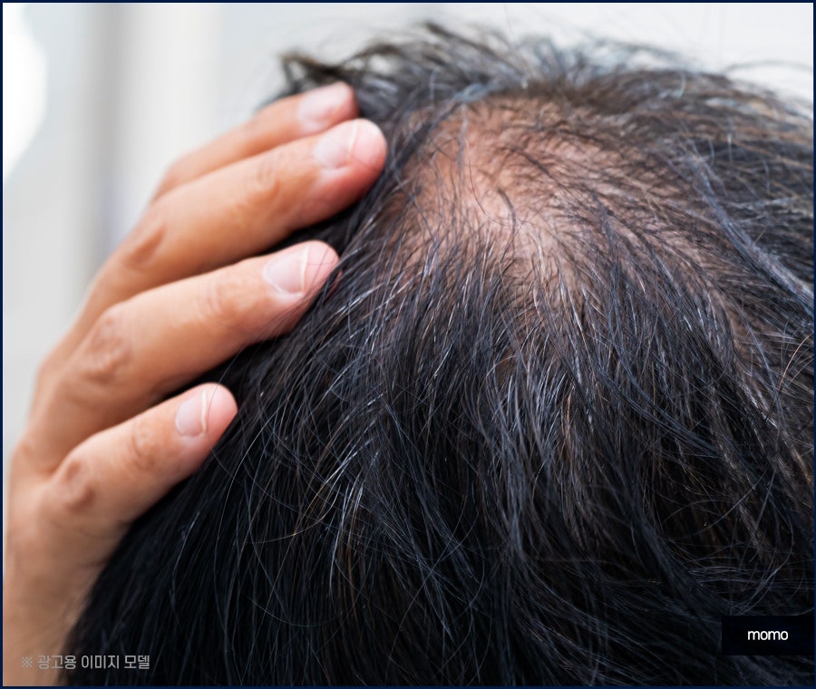 모발이식병원추천 선택 시 꼭 체크할 사항 3가지 관련 이미지 8