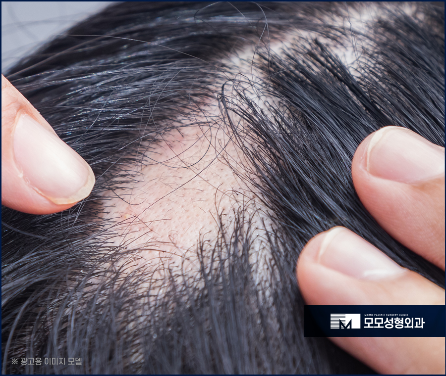 다발성원형탈모 원인부터 해결을 위한 방법 관련 이미지 4
