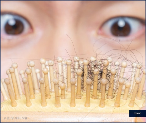 강남 모발이식 병원 차이가 나는 이유는 관련 이미지 4