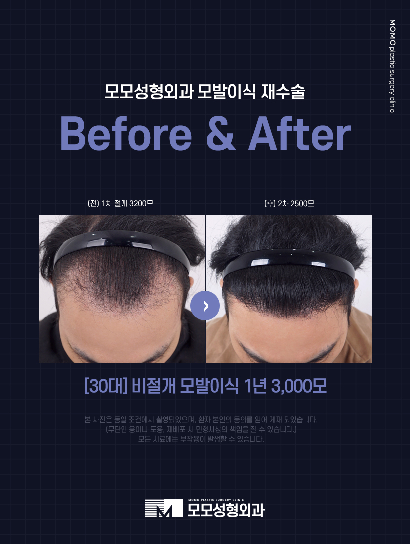 모발이식재수술 만족하기 위해서는 관련 이미지 7