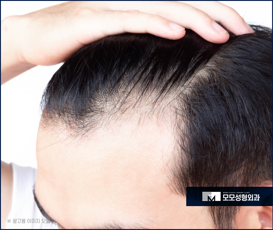엠자탈모모발이식 자연스럽게 채워주는 관련 이미지 11