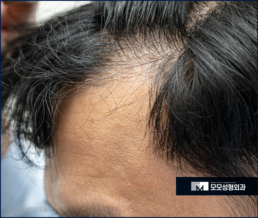 m자형 탈모 보완 시 꼭 짚어야 할 체크 포인트 (ft. 모발이식) 관련 이미지 2