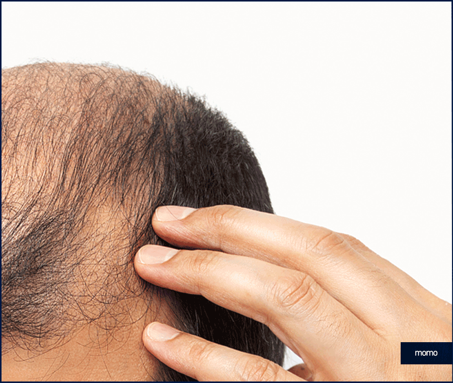 압구정 모발이식 세심한 사전 진단부터 시작하는 곳 관련 이미지 10