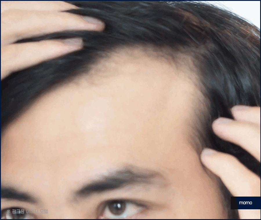 압구정 모발이식 병원 찾고 있다면 꼭 확인하세요 관련 이미지 12