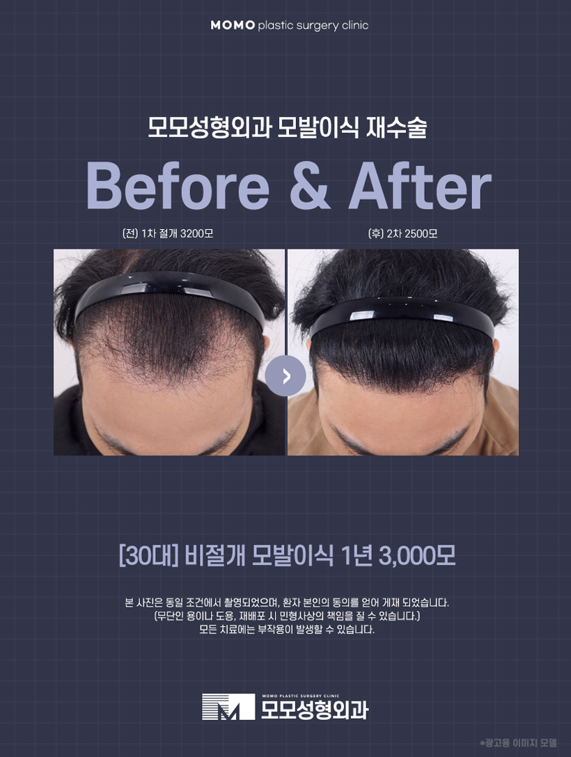 이마축소술 자연스럽게 채워가고 싶다면 관련 이미지 7