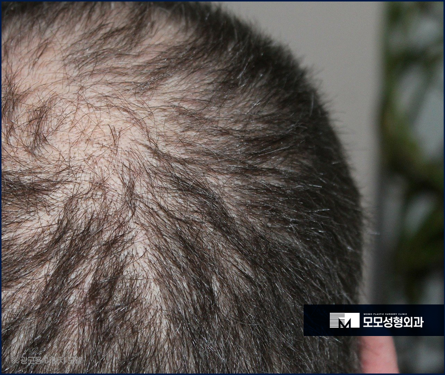 모발이식리터치 여부를 꼭 확인해야 합니다 관련 이미지 4
