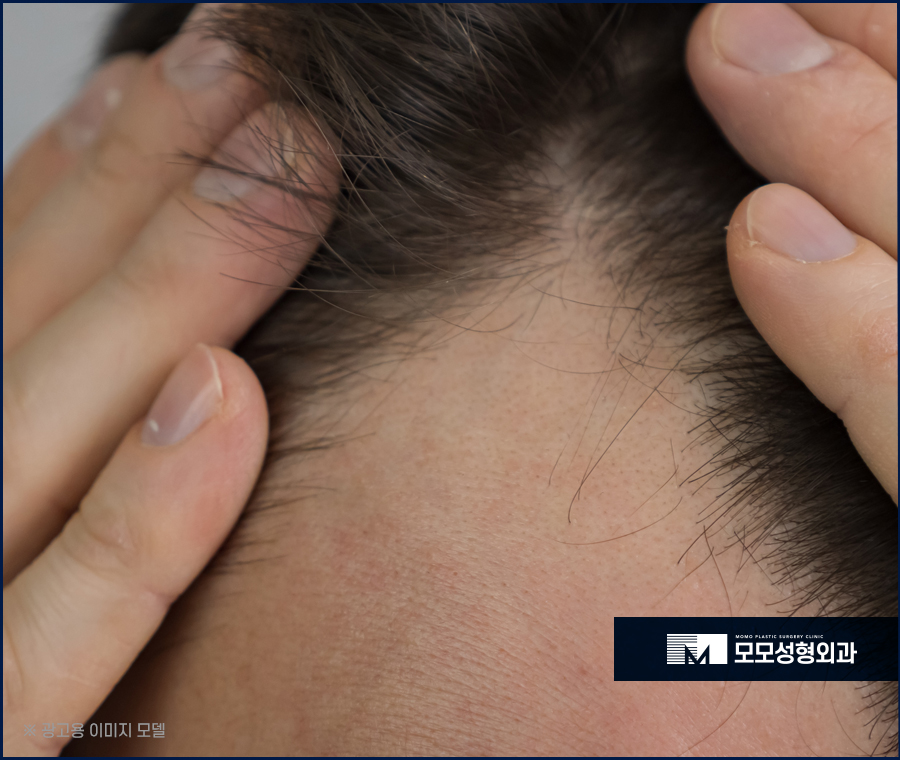 여자M자탈모 사전 예방법부터 발생 시 대처하는 방법 관련 이미지 2