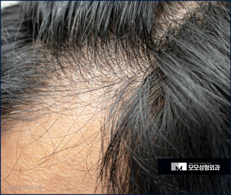 남자헤어라인모발이식 디자인까지 꼼꼼하게 고려하며 관련 이미지 5