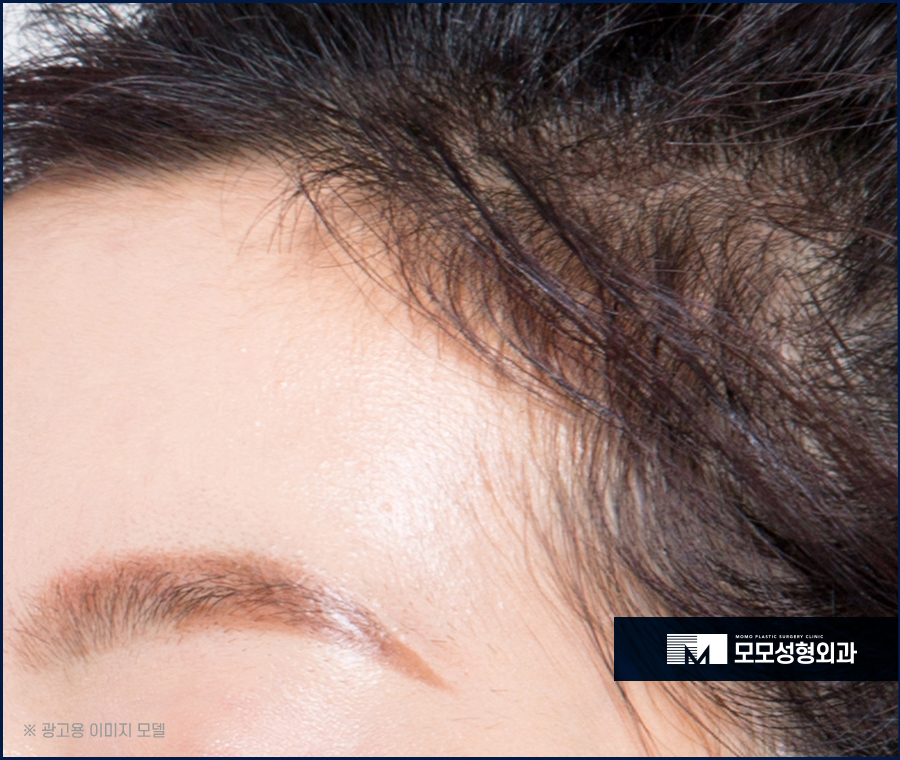 여성헤어라인모발이식 채워 주기 위한 방법은 관련 이미지 3