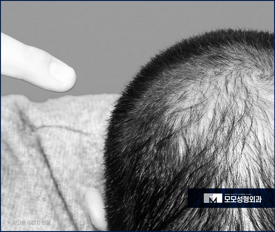 압구정 모발이식 안정적인 생착을 만드는 관련 이미지 3