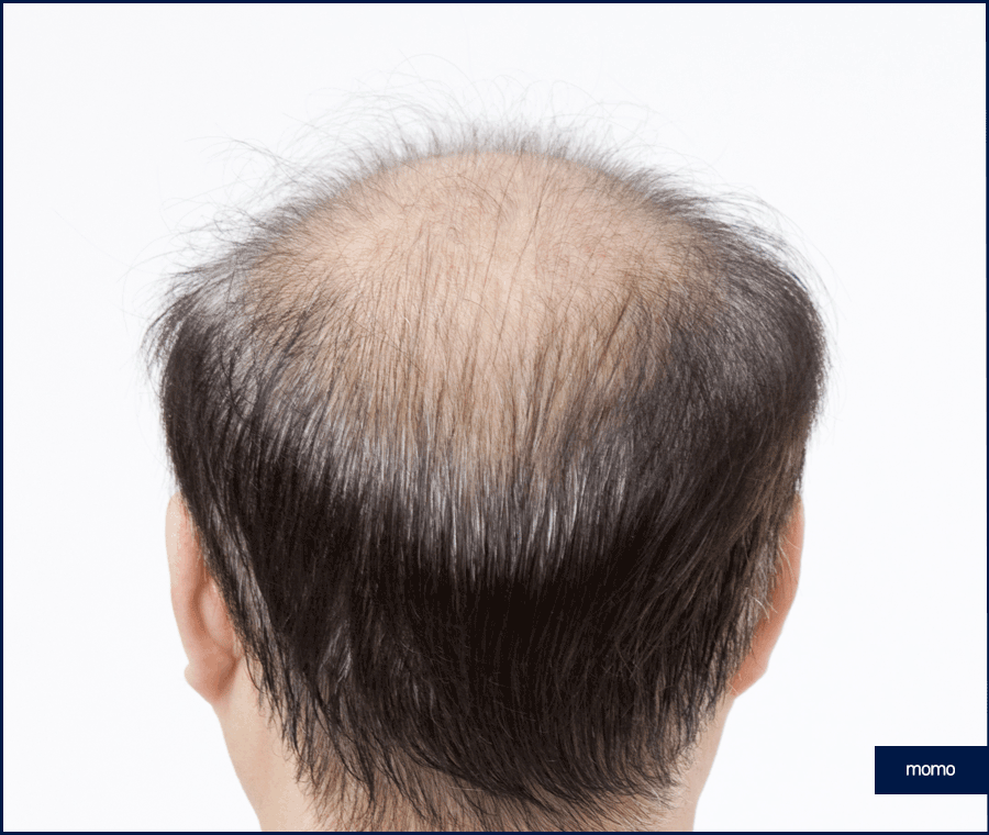 모발이식재수술 원인 및 성공을 위한 핵심 2가지 관련 이미지 10
