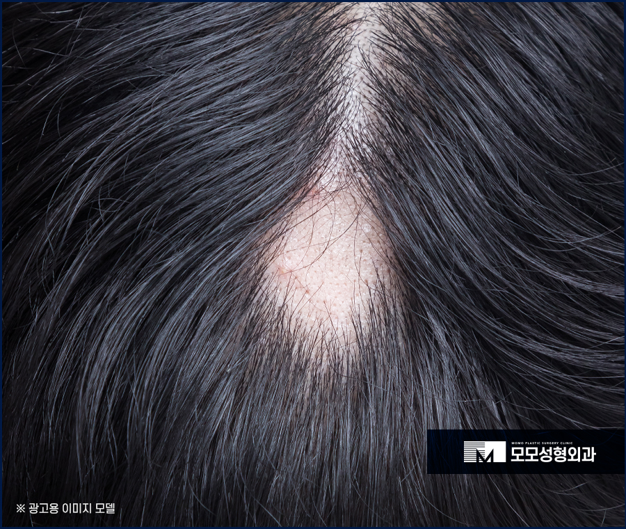 스트레스성탈모증상 다양하게 나뉘어 지는 관련 이미지 3