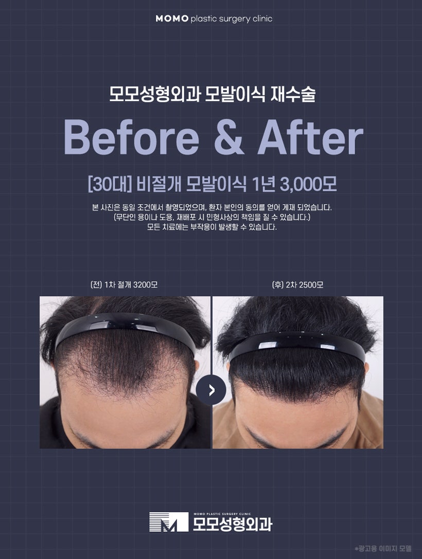 엠자이마 촘촘하게 채워 자연스럽게 보강하는 관련 이미지 6