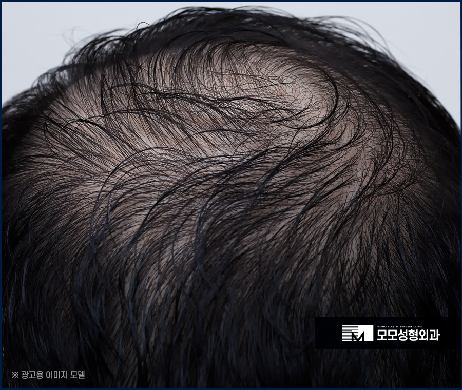 비절개모발이식 비용 넘쳐나는 자신감까지 만드는 관련 이미지 4