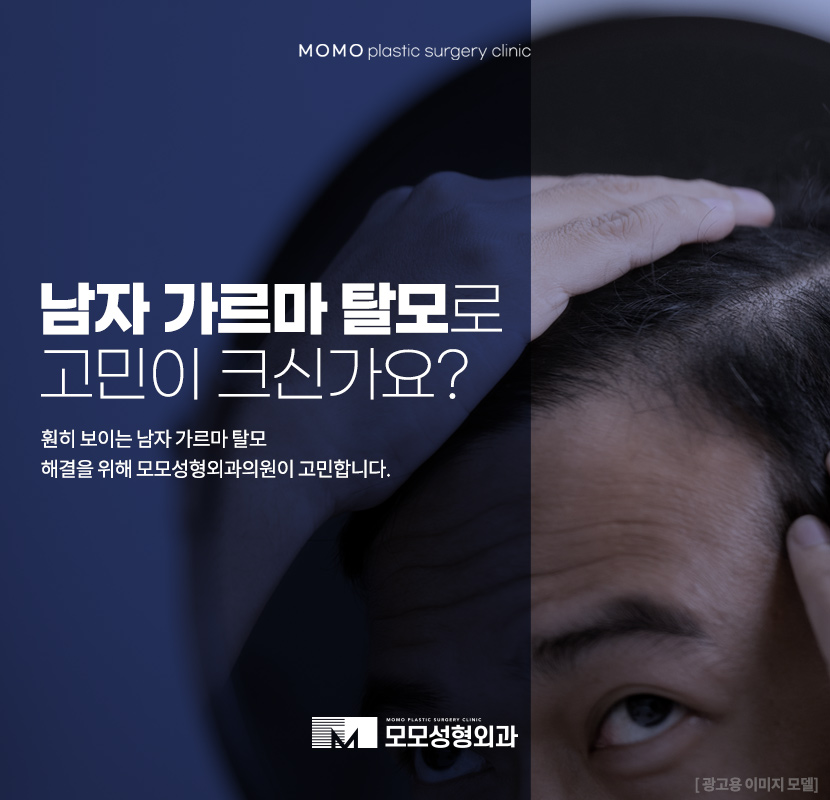 남자가르마탈모 훤하게 보이고 있다면 관련 이미지 1