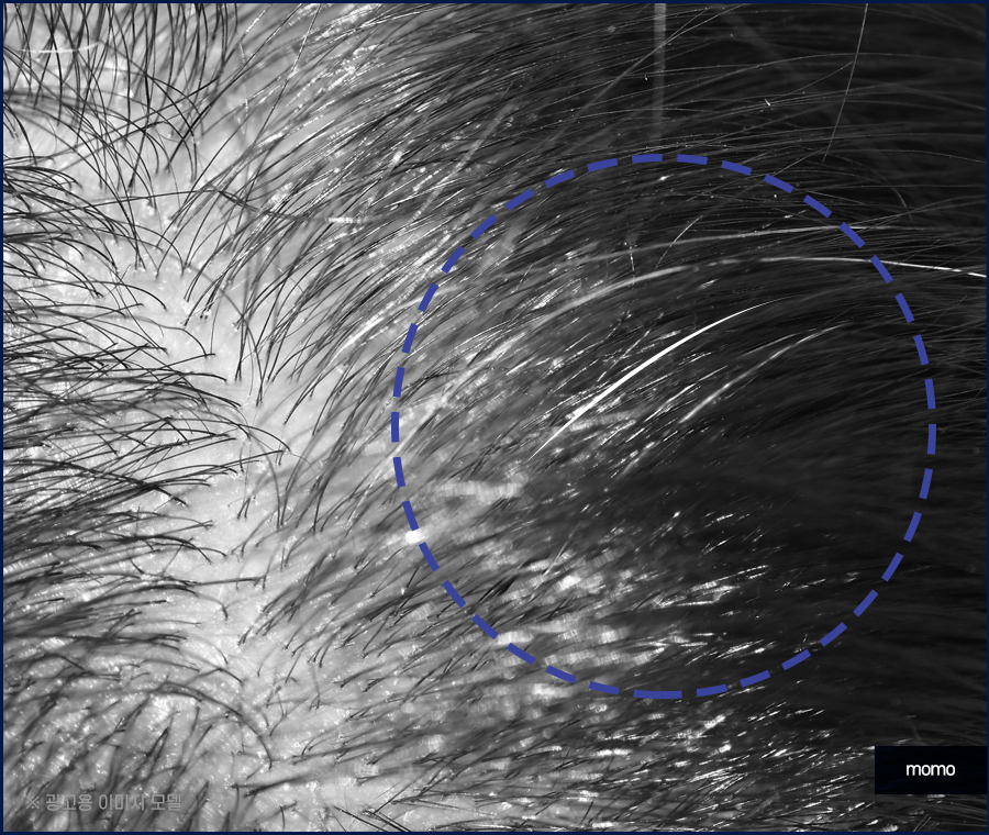 새치나는이유부터 뽑지 말아야 할 이유까지 관련 이미지 8