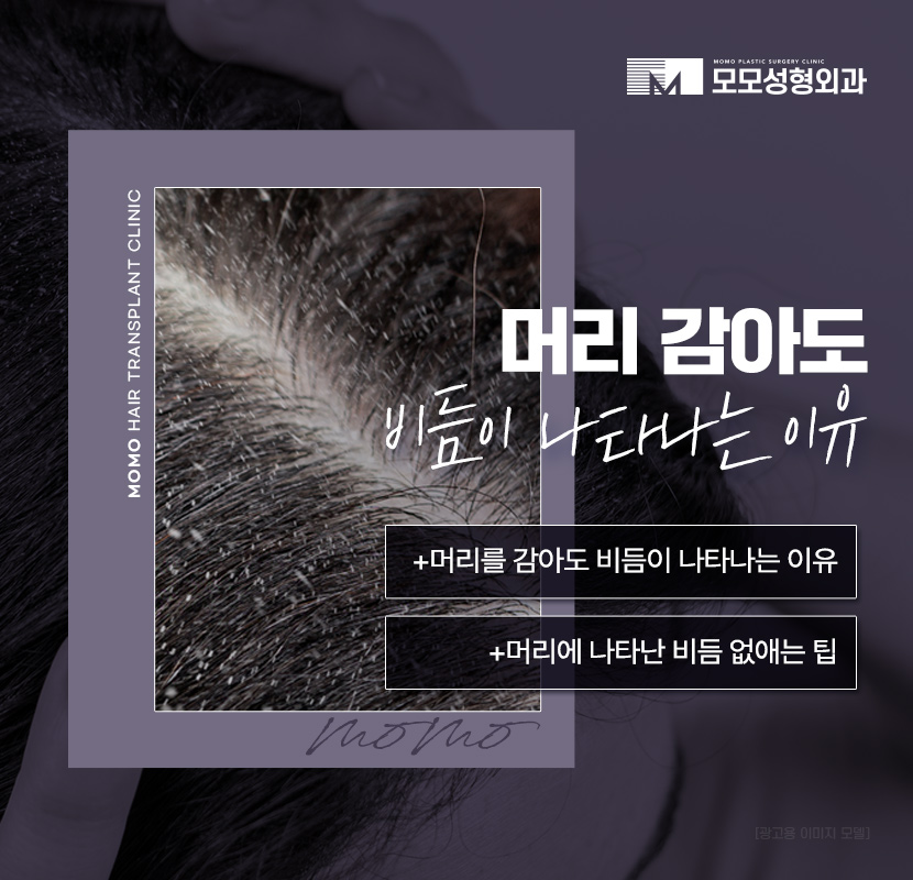 머리 감아도 비듬이 나타나는 이유 및 제거 팁 관련 이미지 1