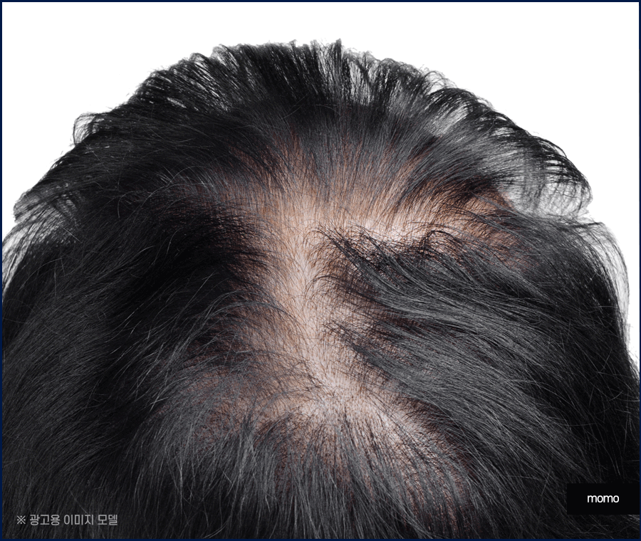 모발이식 생착률 높이기 위한 솔루션은 관련 이미지 6