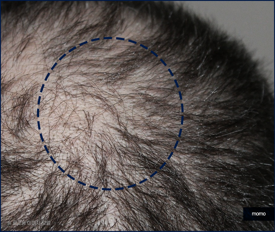머리카락 얇아짐 발생하는 이유부터 회복 방안 관련 이미지 6