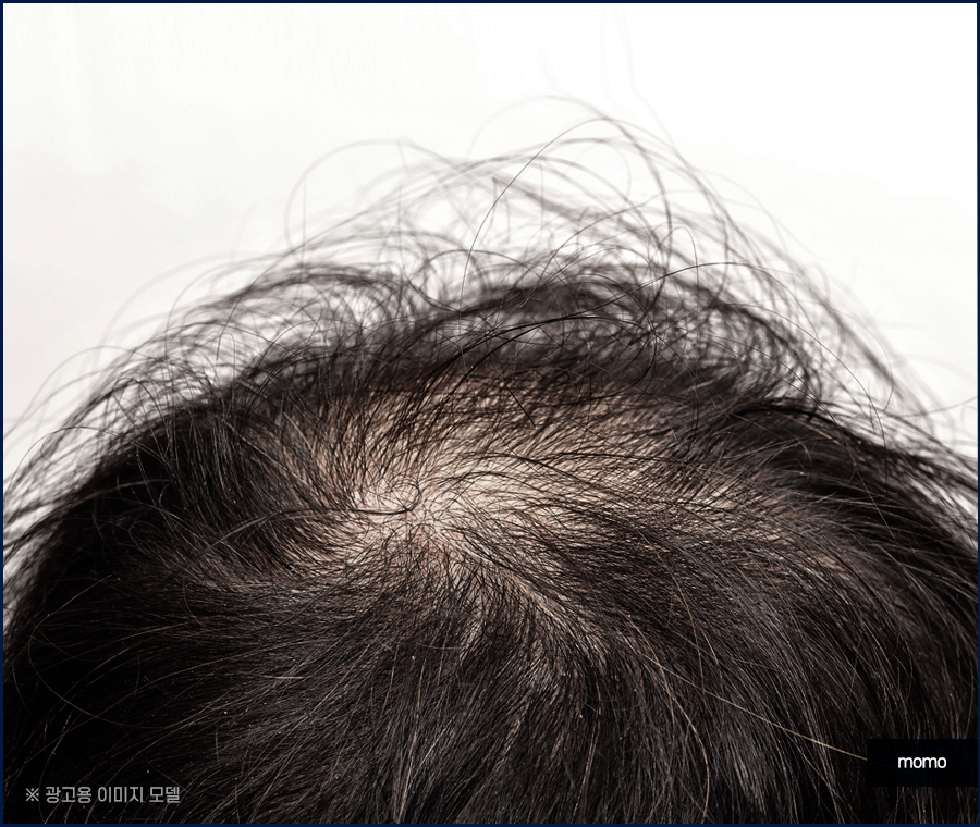 모발이식병원추천 선택 시 꼭 체크할 사항 3가지 관련 이미지 9