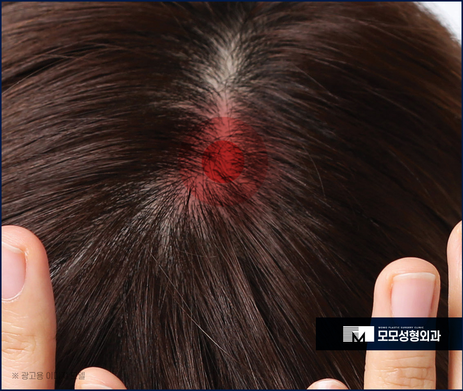 비듬이생기는이유와 해결을 위한 방법 관련 이미지 4