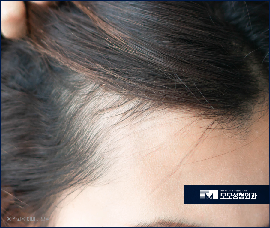 여자헤어라인모발이식 이마 높이 변화로 작은 얼굴 효과 관련 이미지 4
