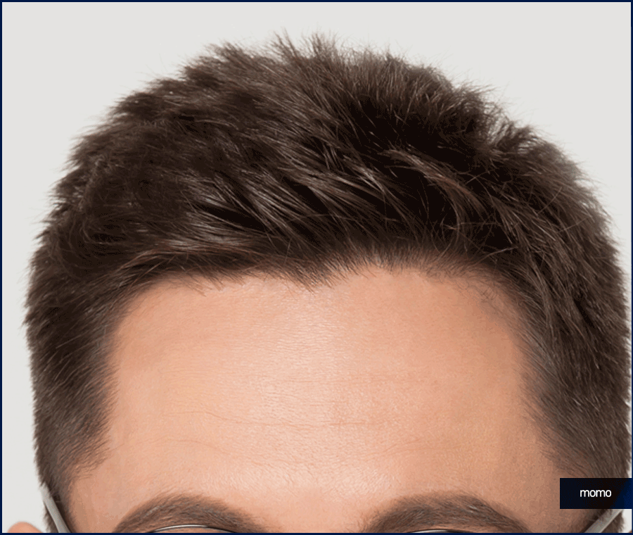 이마 축소술 비용 및 모발이식이 선호되는 이유 관련 이미지 11