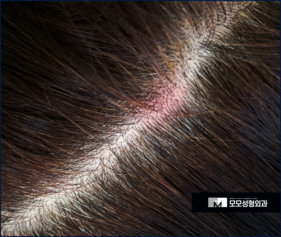 두피 피지낭종으로 인해 발생할 수 있는 문제들 관련 이미지 4