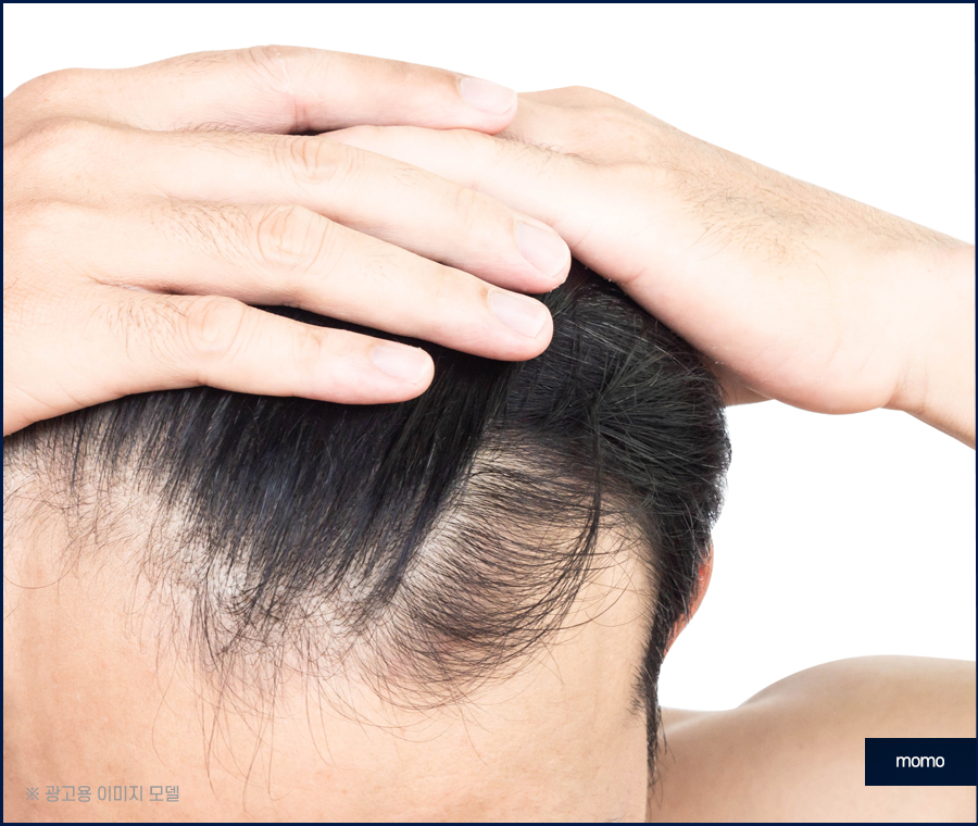 대량 모발이식 확연한 변화를 위해서 관련 이미지 2