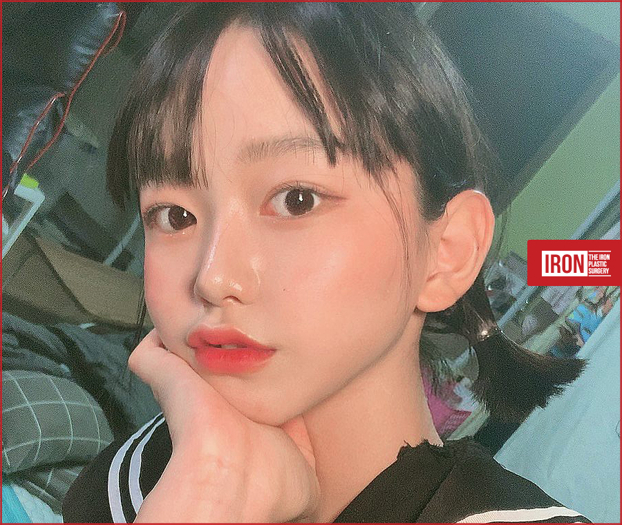 압구정눈성형 알맞은 밸런스로 관련 이미지 4
