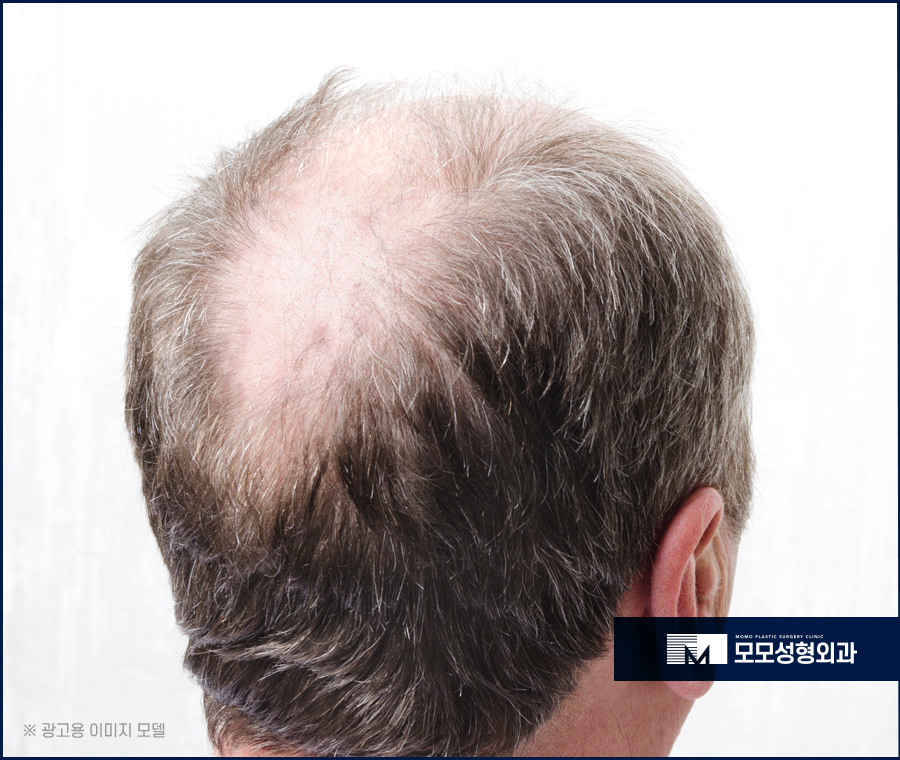 30대 정수리 탈모 초기 증상부터 대응 방법까지 관련 이미지 5