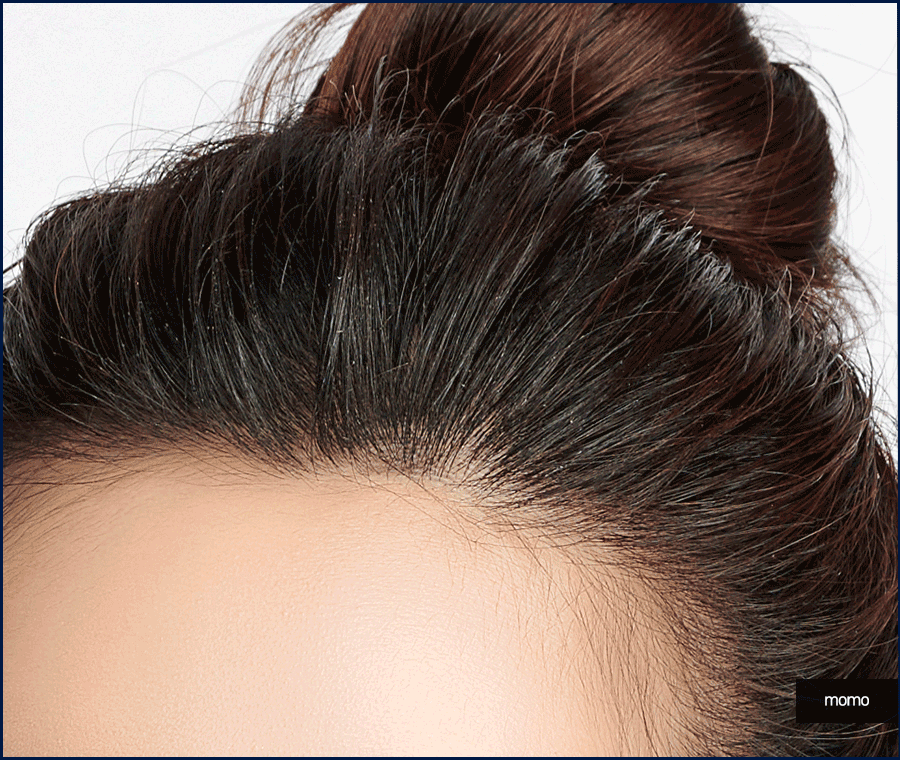 헤어라인 모발이식 비용보다 꼼꼼히 알아볼 조건은? 관련 이미지 11