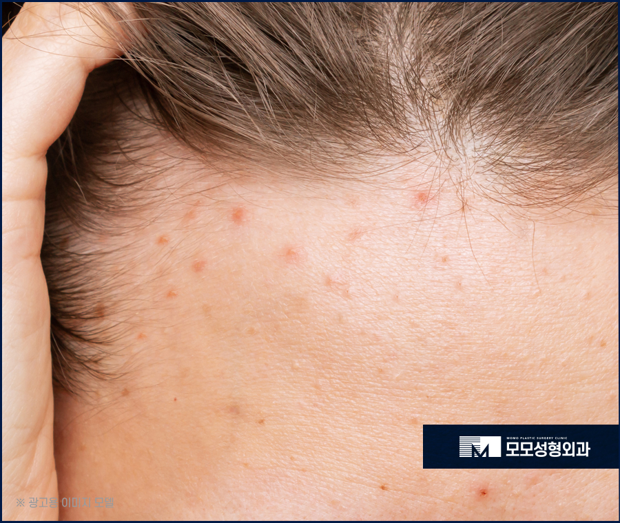 여자넓은이마 고민으로 부터 벗어나는 관련 이미지 6