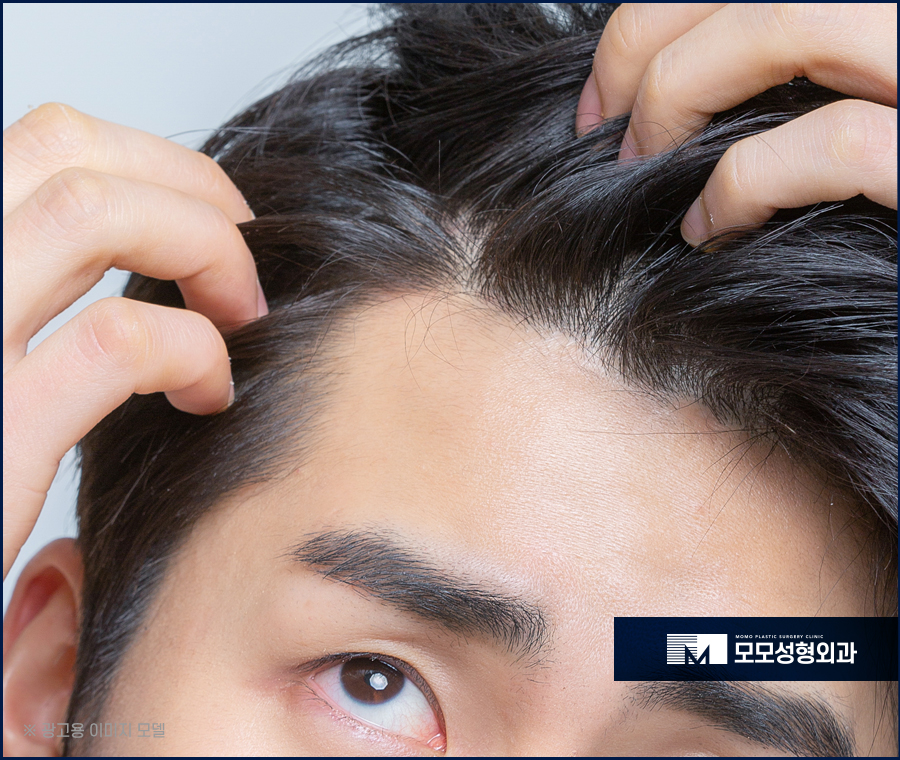 m자형 탈모 보완 시 꼭 짚어야 할 체크 포인트 (ft. 모발이식) 관련 이미지 4