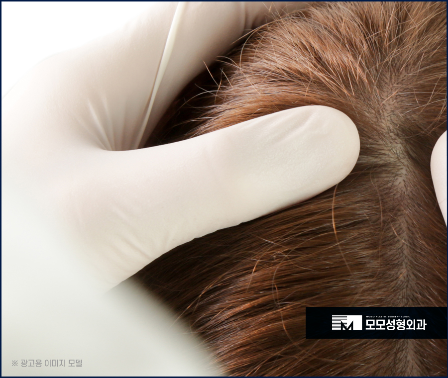 모발이식 암흑기를 이겨내기 위해 알아야 할 점 관련 이미지 4