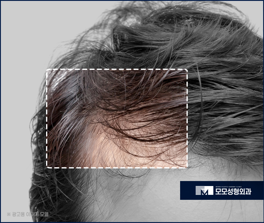 모발 얇아짐 이유와 두께를 복구하는 방법 관련 이미지 4