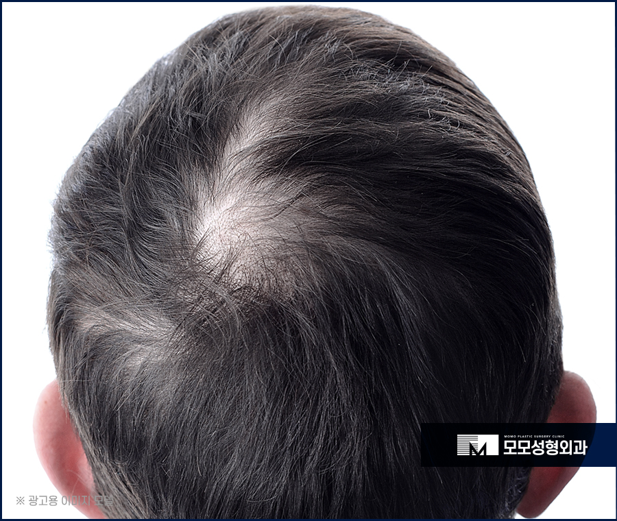 모모성형외과샴푸 공식 출시 관련 이미지 2
