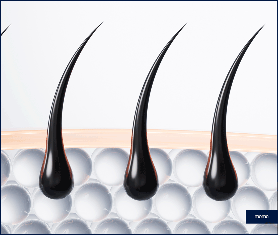 모발이식 2000모 자연스러운 커버 결과 정도는? 관련 이미지 2